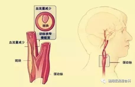 说说老年颈动脉粥样硬化健康教育 首都医科大学附属北京朝阳医院