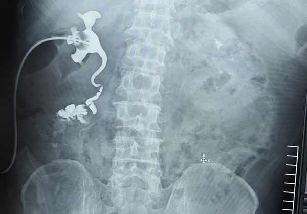 医院成功为车祸伤重症患者实施高难度自体肾移植加输尿管重建手术